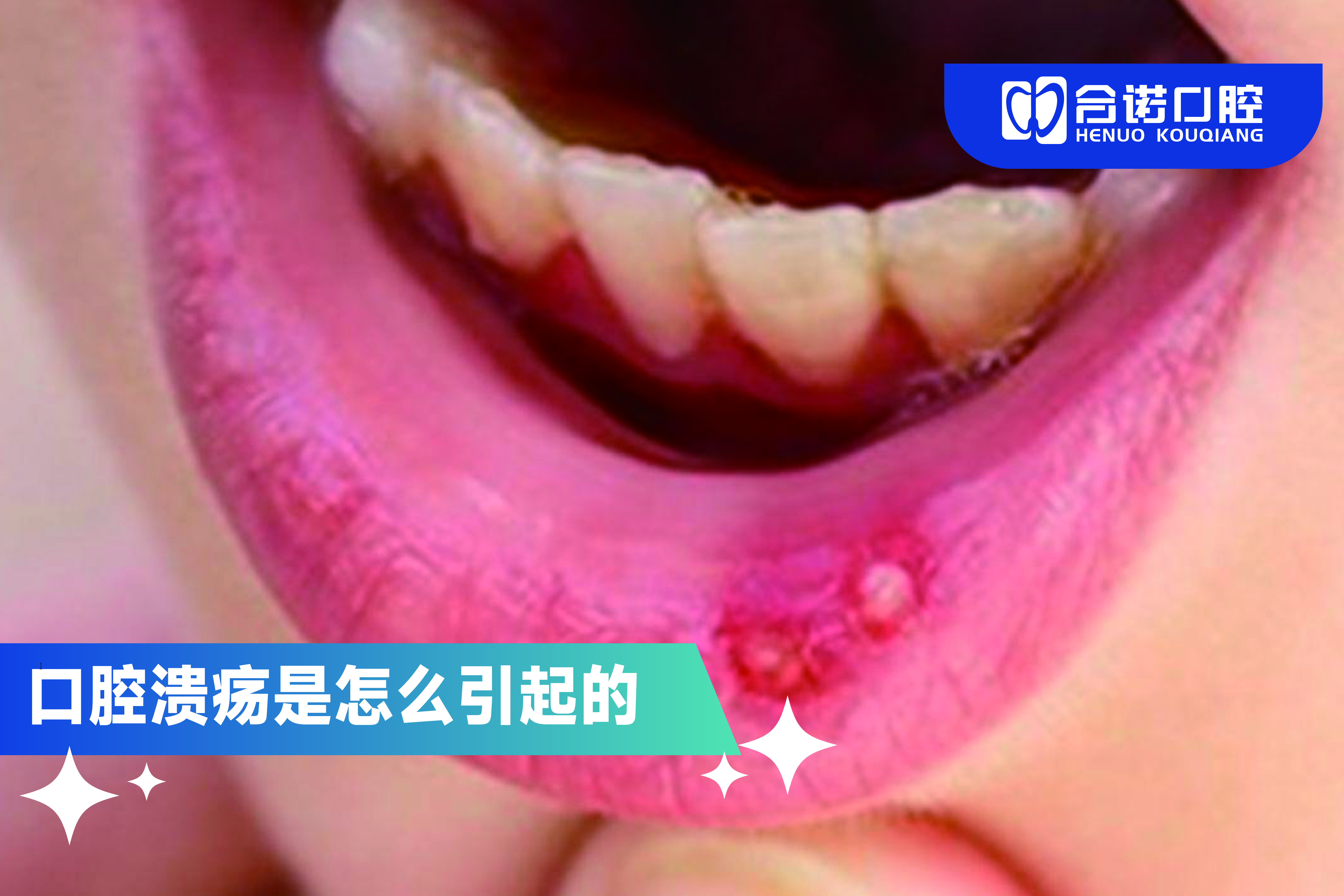 口腔潰瘍的成因、護理方法、用藥建議及就醫提示